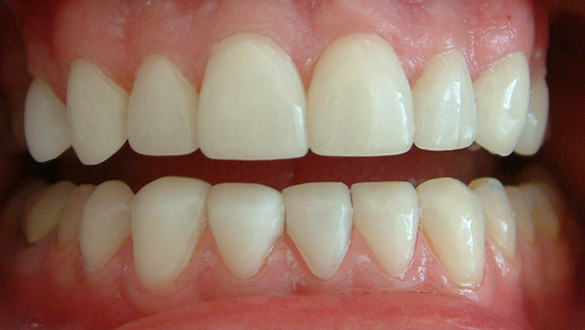 lumineers veneers after