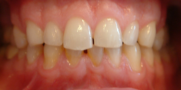 lumineers veneers before