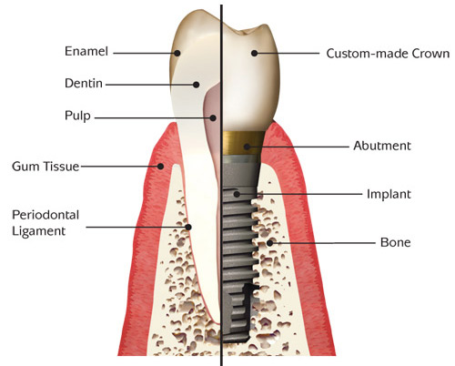 dental implant vs tooth