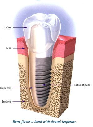 tooth implant