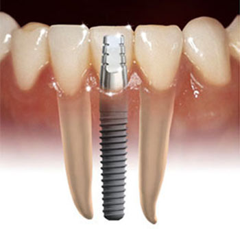 implant for missing tooth